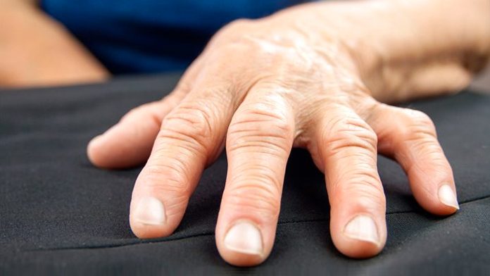 Artrite alle mani? Prova questi esercizi e questi rimedi naturali