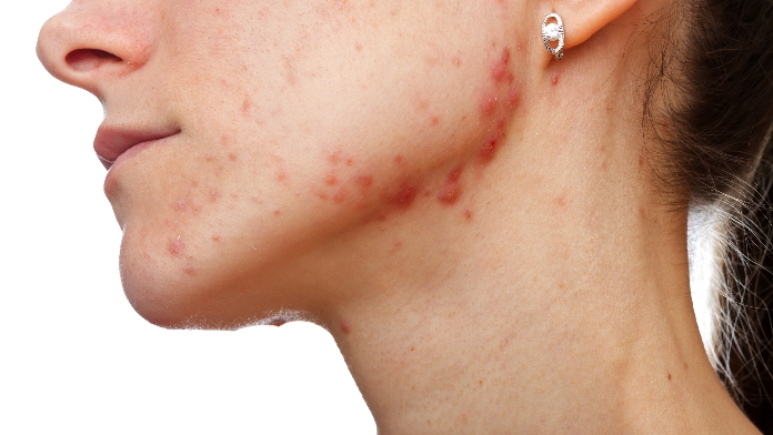 come si eliminano cicatrici acne