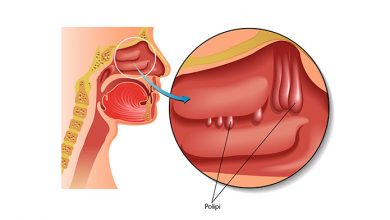 poliposi nasale