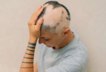 alopecia negli adolescenti