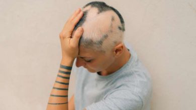 alopecia negli adolescenti