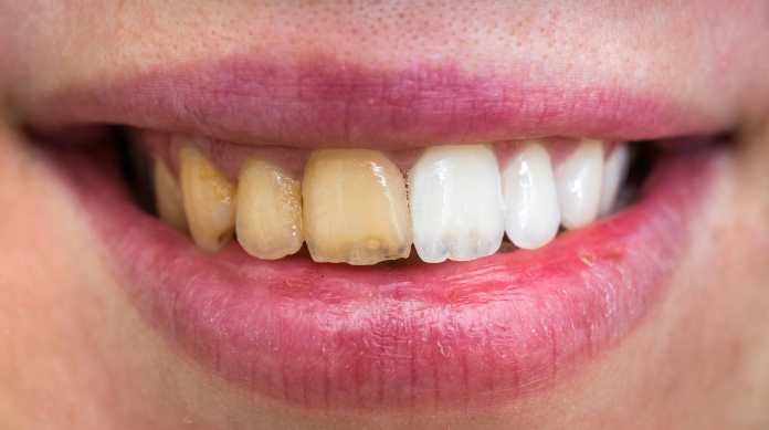 alimenti che macchiano i denti